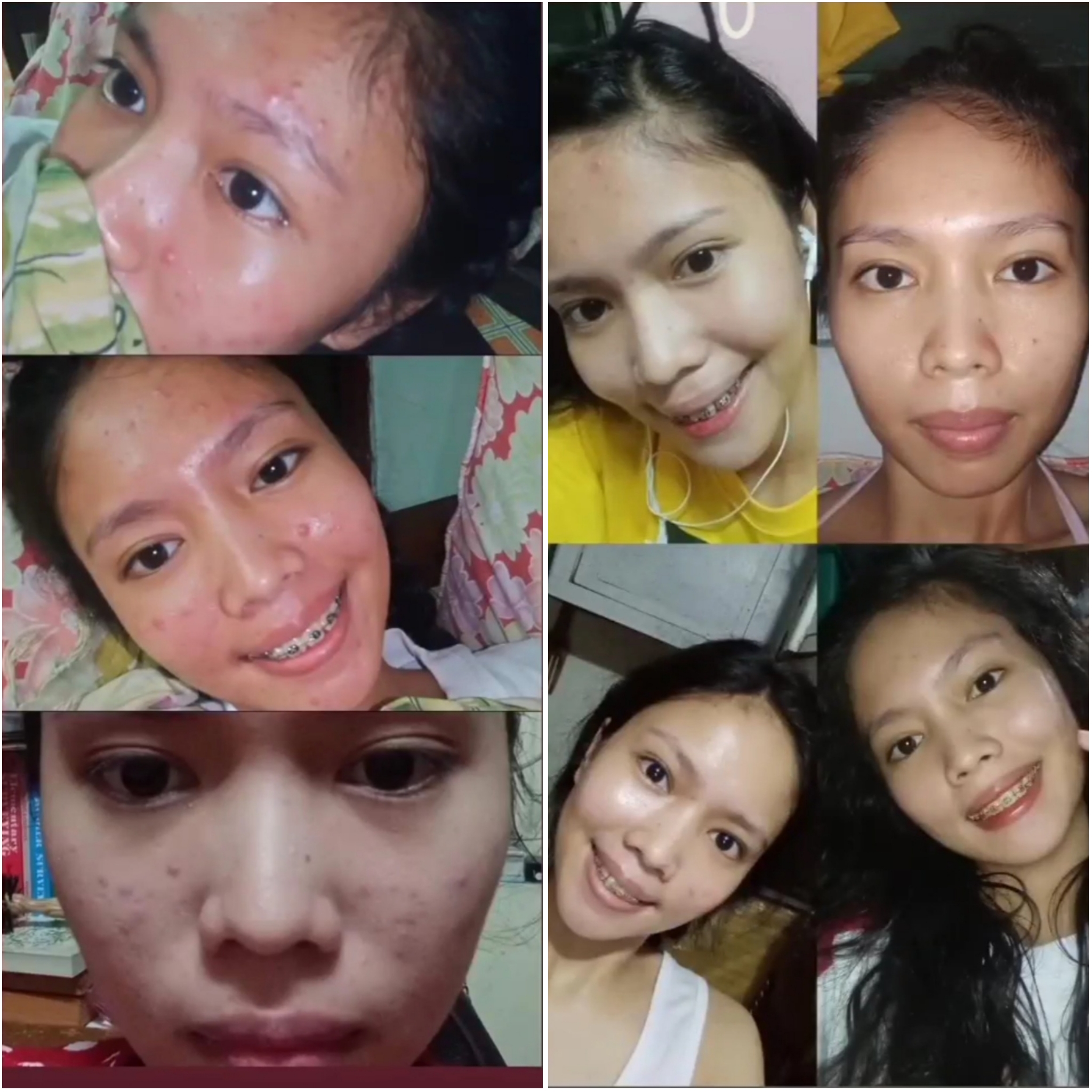 @abelynn_acne_before_after_ problem skin