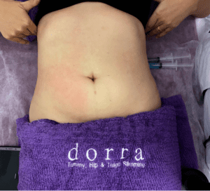 Dorra Slimming Treatment: I'm A Sceptic Who Tried It To See If It