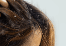 Scalp Psoriasis: We share how to treat it with this budget friendly shampoo Scalp Psoriasis: We share how to treat it with this budget friendly shampoo