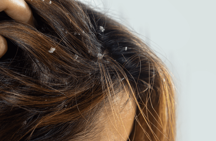 Scalp Psoriasis: We share how to treat it with this budget friendly shampoo