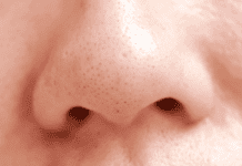 Những sản phẩm trị mụn đầu đen được đánh giá hàng đầu sản phẩm trị mụn đầu đen