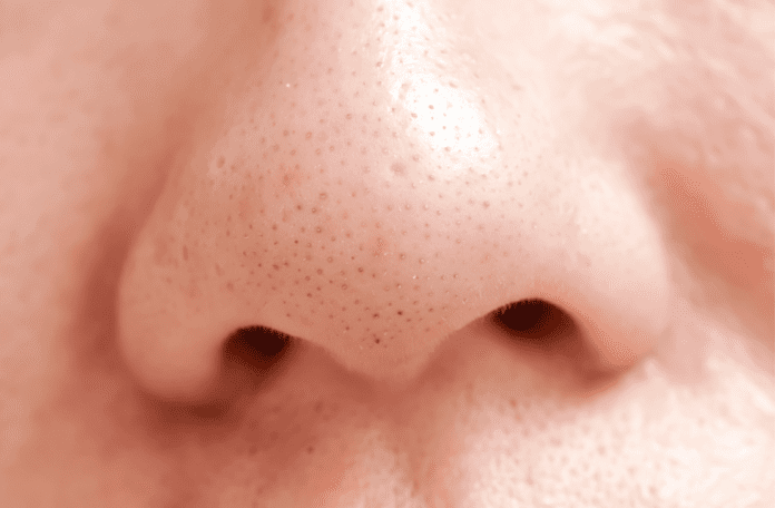 Blackheads