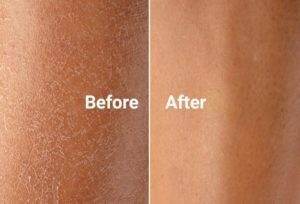 Before and after skin status using Bio-Oil Lightweight Body Lotion